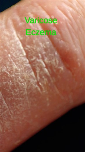 Varicose Eczema: Simple Leg Care Tips You Should Know 🌿