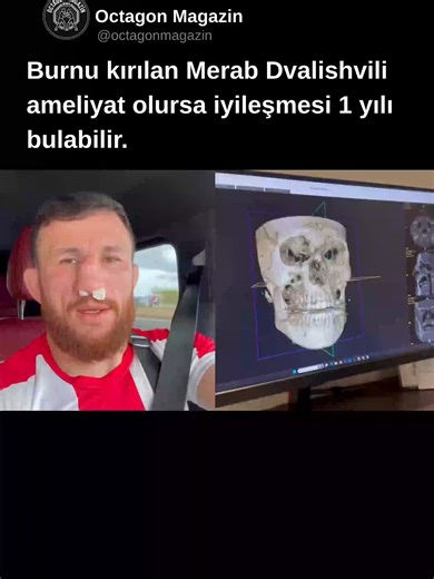 Merab Dvalishvili talihsiz bir kazada burnunu kırdı. Doktorlar, ameliyat olup burnunu düzelttirmesi halinde iyileşme sürecinin tam 1 yıl süreceğini söyledi. Peki o ne yaptı? Kafeslerden ve unvan yarışından uzak kalmamak için ameliyatı reddetti! Doktorun