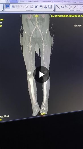 Pushing image quality further in CT Angiography VR reconstruction of Lower Limb CTA performed on GE Revolution Maxima 128-slice using a dual injector protocol (80 cc Omnipaque 350 + 50 cc saline… | Ali Mohamed