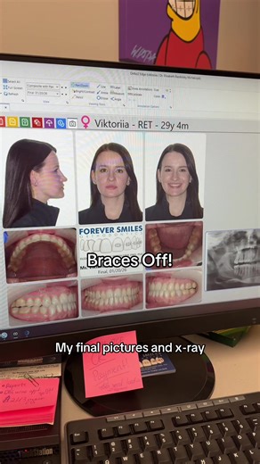My Braces Journey: Braces Off After 17 Months!