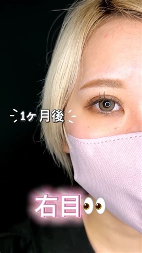ルラ美容クリニック静岡院｜小顔・ヒアル・肌質改善 on Instagram: "🌟二重埋没法ルラループニ重術のモニター様です🪄 とても綺麗なくいこみしっかりでばっちり印象的なお目元でより可愛くなりました🌷 1ヶ月でしっかり腫れが引き完成となります🫧 元々二重の方もアイプチでくい込みを強くしているなどのくい込みの強さも調節していきます🎀 二重になりたい、左右差をなくしたい、幅を変えたい、色々なお悩みをご相談ください💗 カウンセリングは無料です📢 せひお気軽にご相談ください✨ 【二重埋没法】 ■施術内容 まぶたの数所を専用の糸で結び留めることで二重を作る施術です。 切開する場合に比べて傷は目立たず、腫れが少ないことが特徴です。 想定されるリスクなど ♥腫れ術後数日から1週間。 ♥内出血 まれ。メイクで隠せる程度。 ♥左右差元の骨格や目の形によります。 ♥角膜損傷ほぼ起きないが報告例あり。 #ルラ美容クリニック#ルラ美容クリニック静岡院"