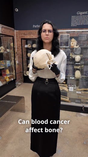 54K views · 12K reactions | Multiple myeloma leaves its mark on the...