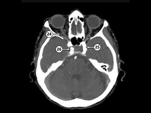 Normal CT Angiography of the Brain: A Step-by-Step, Labelled Approach