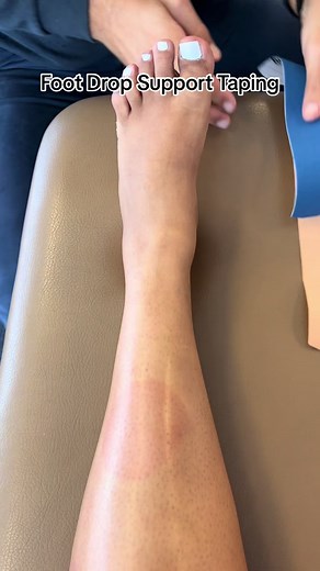 Taping for foot drop along the anterior tibialis (frint of leg) and along the peroneus longus (side of leg) helps activate those muscles to help the foot from droping during walking. #physicaltherapy #sportsinjury #injuryrecovery #runninginjury #footpain #ankleinjury #kenesiotape #tiktokfitness