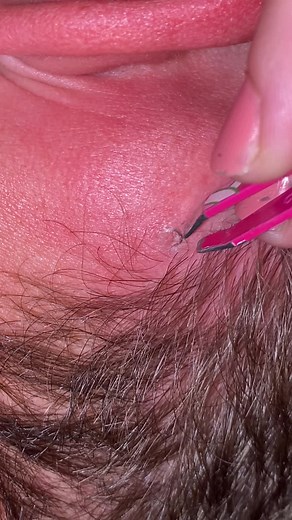 The Ultimate Guide to Effective Hair Removal: Say Goodbye to Ingrown Hair!