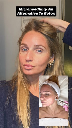 Veronica Victoria on Instagram: "The Raw Microneedling Journey! Sharing the before, after and in between. 💆🏼‍♀️ and channeling Samantha Jones along the way. What is Microneedling? •Also called collagen induction therapy, it uses fine needles to create micro injuries in the skin. What it does? •This triggers your body’s natural healing process to boost collagen and elastin. •It results in smoother and firmer skin. •Reduces wrinkles, fine lines, acne scars, stretch marks, pores, & uneven skin. I