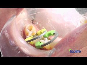 Isolite- The best isolation system for dental posterior composites