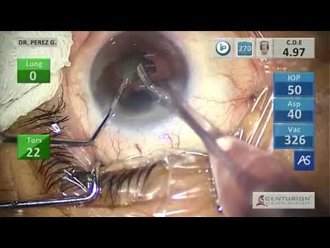 Facoemulsificación con el equipo CENTURION de ALCON