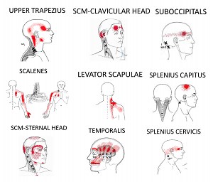 Get Relief From Tension Headaches - The Armoury
