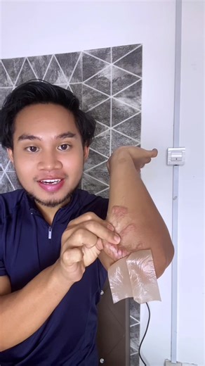 Effective Keloid and Scar Removal Techniques