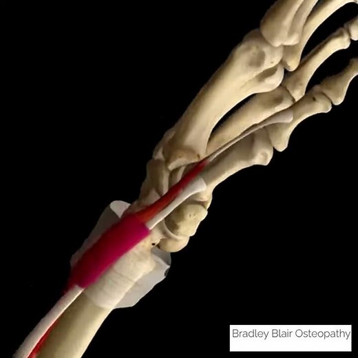 De Quervain Syndrome