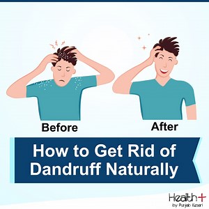 14K views · 172 reactions | How to Get Rid of Dandruff Naturally | Health+ | Facebook