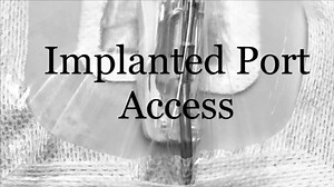 Implanted Port Access with the 3M Tegaderm CHG Dressing