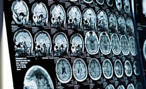 Potential Psychosis Biomarkers are Identified | Clinical And Molecular Dx