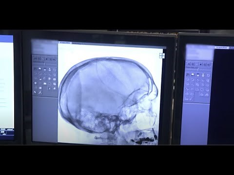 Brain Aneurysm Signs & Symptoms from Memorial