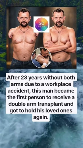 First Double Arm Transplant After 23 Years