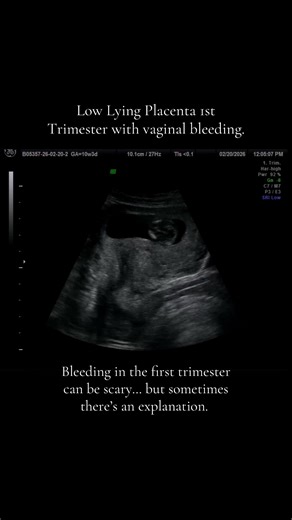 Understanding Low-Lying Placenta During Pregnancy