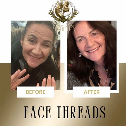 Face Threads: The Non-Surgical Lunchtime Facelift