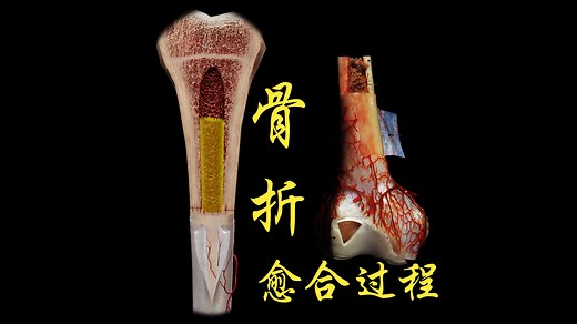 骨折后，断端是怎么愈合的？