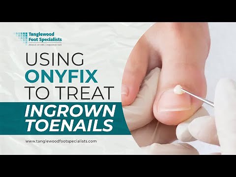 Using Onyfix to Treat Ingrown Toenails - PAIN FREE!