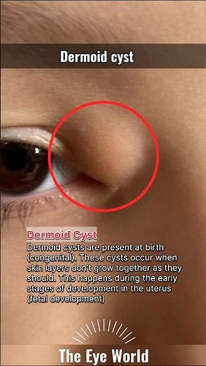 the Eye World™:dermoid cyst #eyes #opthalmology #viral #youtubeshorts