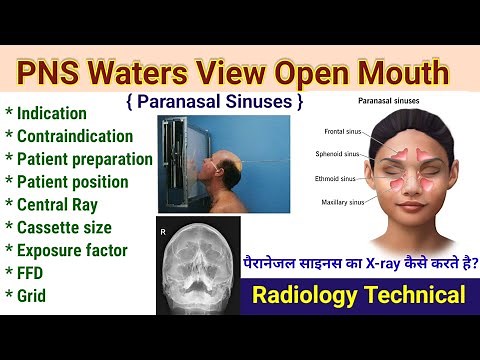 PNS Waters view # Open mouth X-ray # Parasal sinuses projection # facial Radiography #radiography