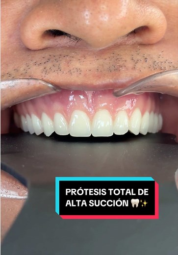 Prótesis Dental de Alta Succión R DENTAL STUDIO
