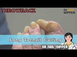 Long Toenail Cutting - Throwback #5