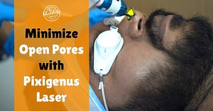 111K views · 99 reactions | #Whiteheads, #blackheads, #pimples,...