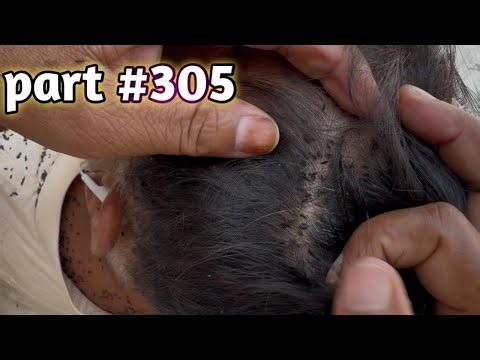 #nitsremoval wife removed lices from husband long hair || husband nitpicking by wife hair {part306}