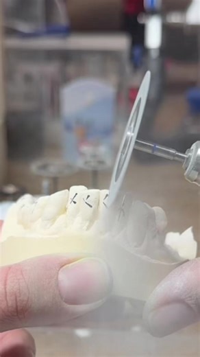 All About Dental Retainers: Types and Care Tips