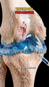 How Visco-Gel Knee Injection Is Done | Visco supplementation Procedure Explained #kneepainrelief