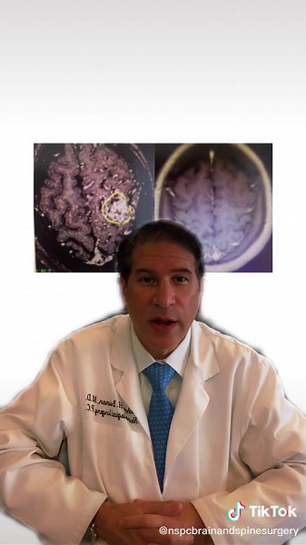 Dr. Michael Brisman Explains Brain AVMs and Treatments