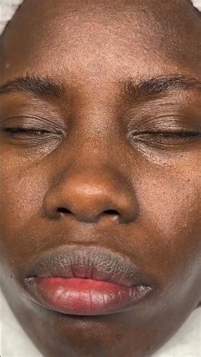 Extraction des points noirs ! #facial #pointnoirtraitement #extraction