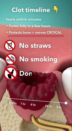 🩸 When does the blood clot form after a tooth extraction? Faster than you think.