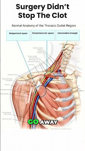 Thoracic Outlet Syndrome Failed Surgery Outcomes and Recurrence Explained