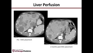 Role of Hepatic Artery Infusion Pump Chemotherapy for Metastatic Colorectal Cancer