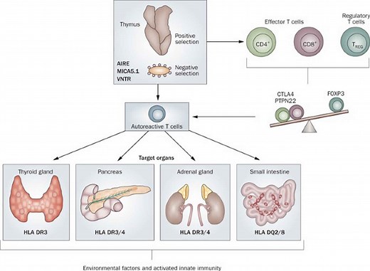 Autoimmune polyendocrine syndrome causes, types, symptoms, diagnosis & treatment