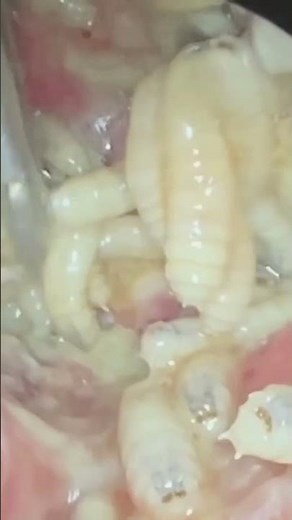 Nose maggots- huge removal