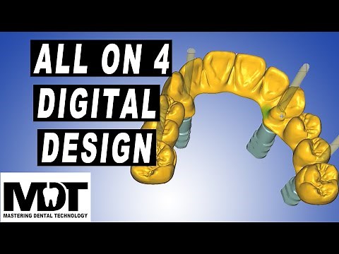 Exocad Implant Screw retained All on 4 Tutorial in Plovdiv 2.4