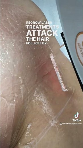 Hollywood Laser Hair Removal Treatment in Action! #laserhairremoval #laserhairremovaltreatment