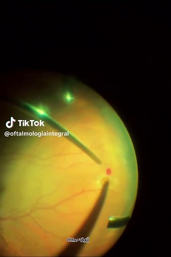 Laser Treatment for Retina Holes Explained