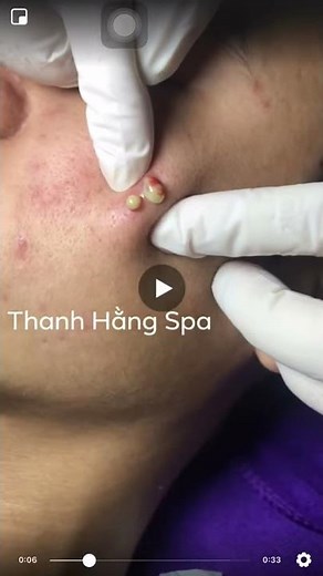 Big Infected Cystic Acne Removal On Face | Spa Đặc trị Mụn | 0906444773
