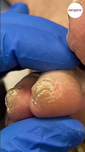 Tip of Toe Callus Removal by Podiatrist