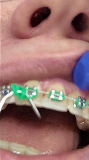 Relaxing sound effect of overbite & underbite correction #dentist #braces #teethwhitening #asmr #sfx