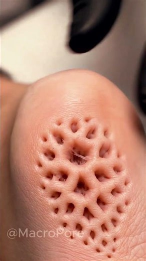 Heel Sebum Extraction (Macro) | Satisfying Shorts