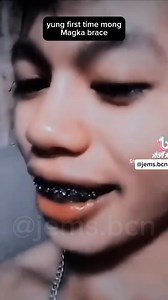 Naka Brace Nako 😂✌🏽 #JemsBcn #Braces #Comedy #Humor | Jems Bcn
