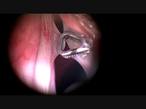 Microlaryngoscopy and removal of a vocal cord cyst