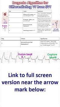 Brugada Algorithm for Differentiating VT from SVT