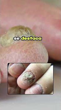 Nail Fungus 🦠 How to Eliminate It Quickly and Effectively
